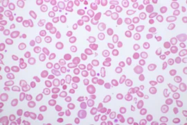 E_25_08_27_The good the bad and the ugly - Navigating blood smears_300x200.png